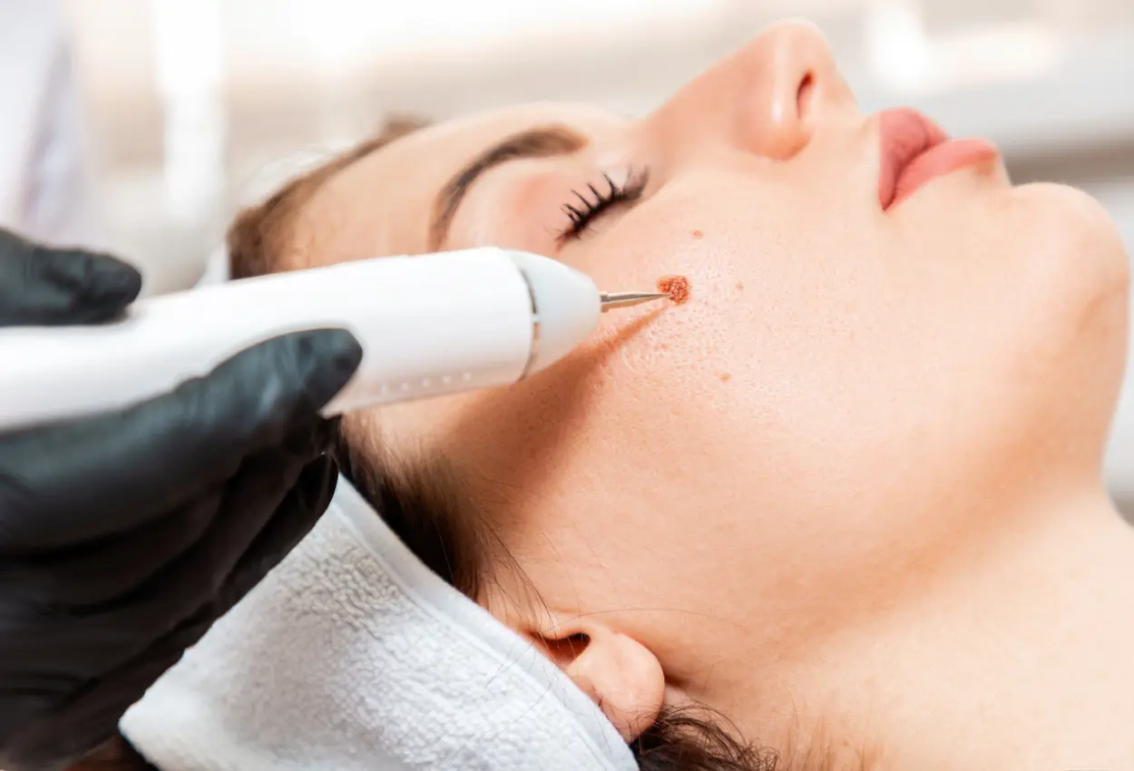 Frequently Asked Questions About Multiple Cryotherapy Treatments Tamworth