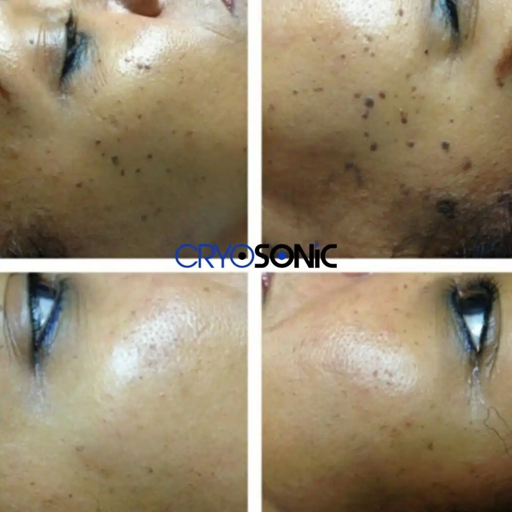 Why Skin Shows Pigmentation After Treatment Tamworth
