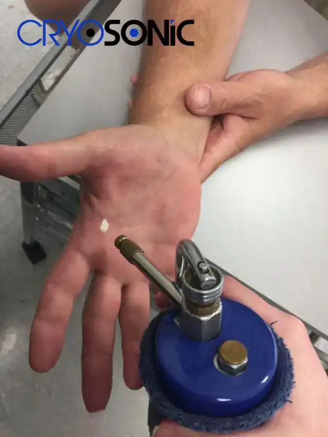 Temperature Differences: OTC vs Medical-Grade Cryotherapy Tamworth